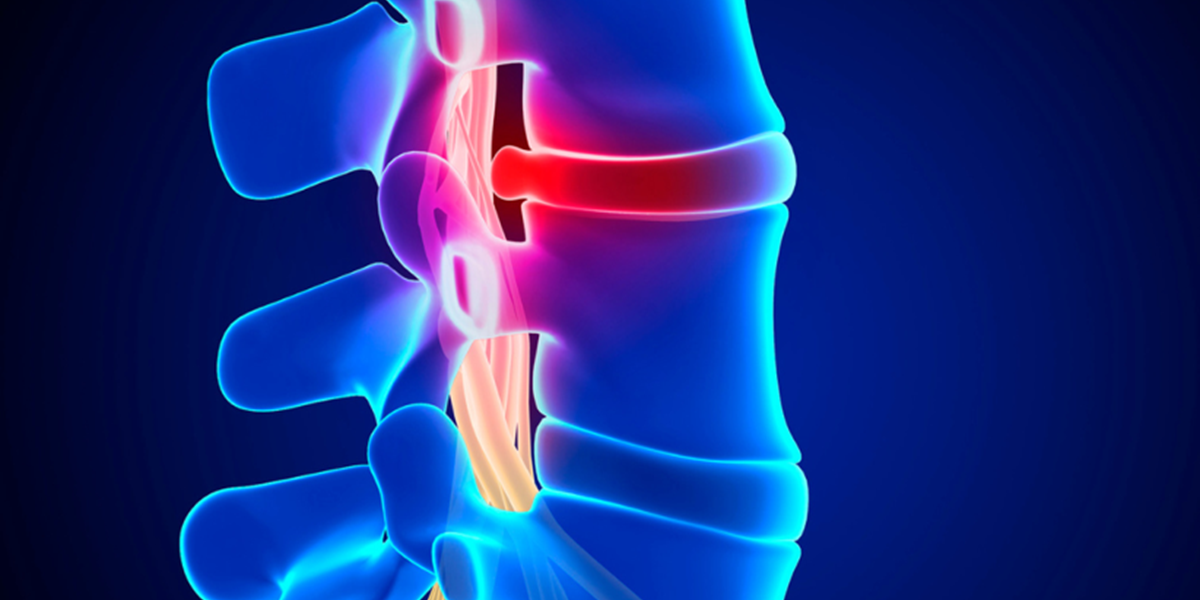 Laser Therapy for Disc Herniation? Celtic SMR